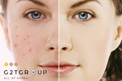 4 Cách trị thâm mụn để da thâm đón Tết